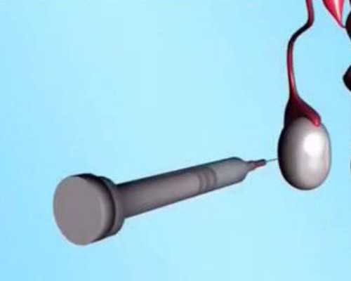 卵子质量会不会影响泰国试管成功率