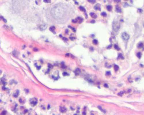 患了低磷酸酯酶症可治好吗