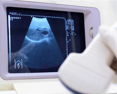 医生建议全部养囊是代表胚胎质量差吗？