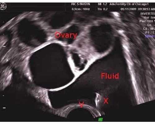 成都助孕妈妈臀抽脂后的效果