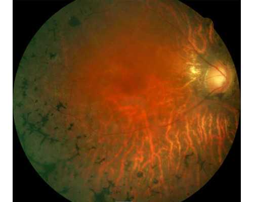 泰国试管婴儿做染色体检查是什么原因