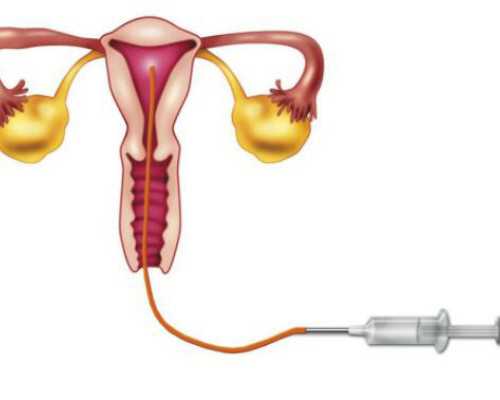 清宫手术后多久可以恢复正常术后是不是很难怀孕-代生试管生子