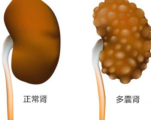 男性得了淋病能治好吗