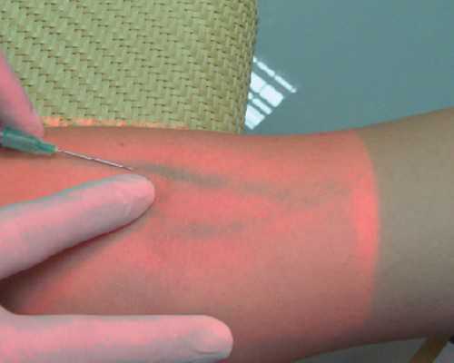 试管婴儿取卵后肚子痛是怎么回事？